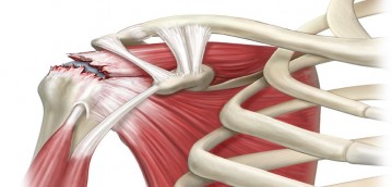Повреждение сухожилия плеча