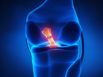 Травма коленного сустава, разрыв связки ПКС